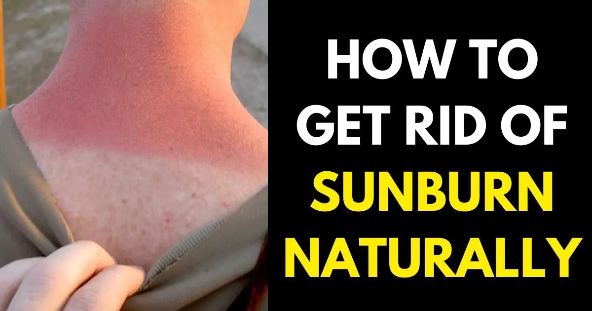 HOW TO GET RID OF SUNBURN NATURALLY