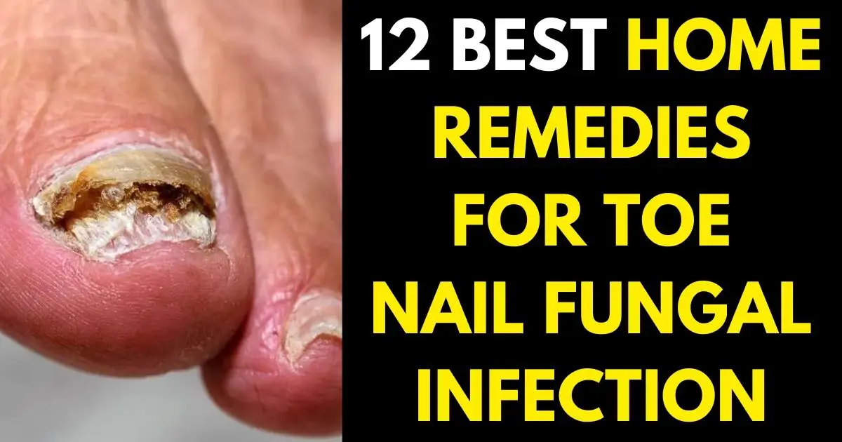 Remedies for Toe Nail Fungal Infection