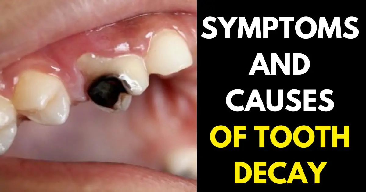 CAUSES OF TOOTH DECAY